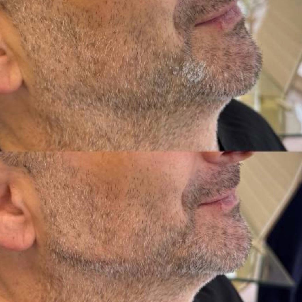 Before and after — jawline definition
