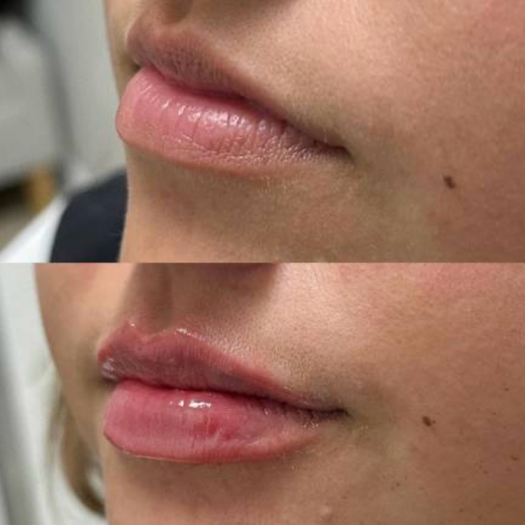 Before and after — lip augmentation
