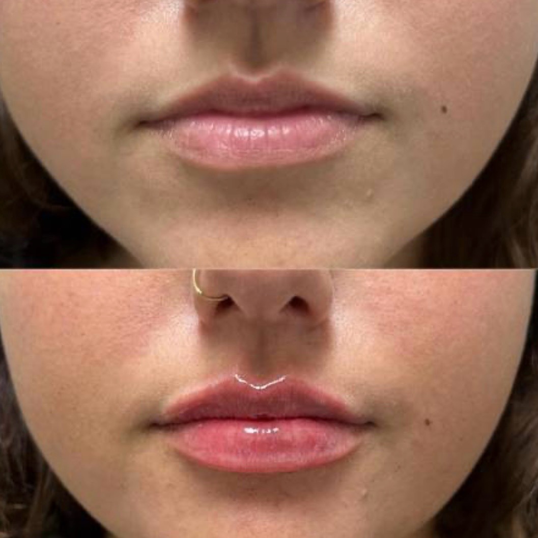 Before and after — lip augmentation