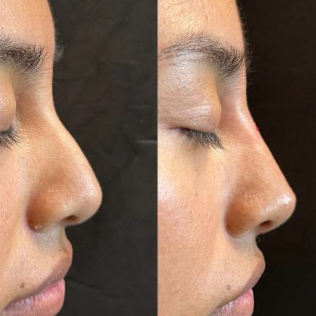 Before and after — non-surgical rhinoplasty