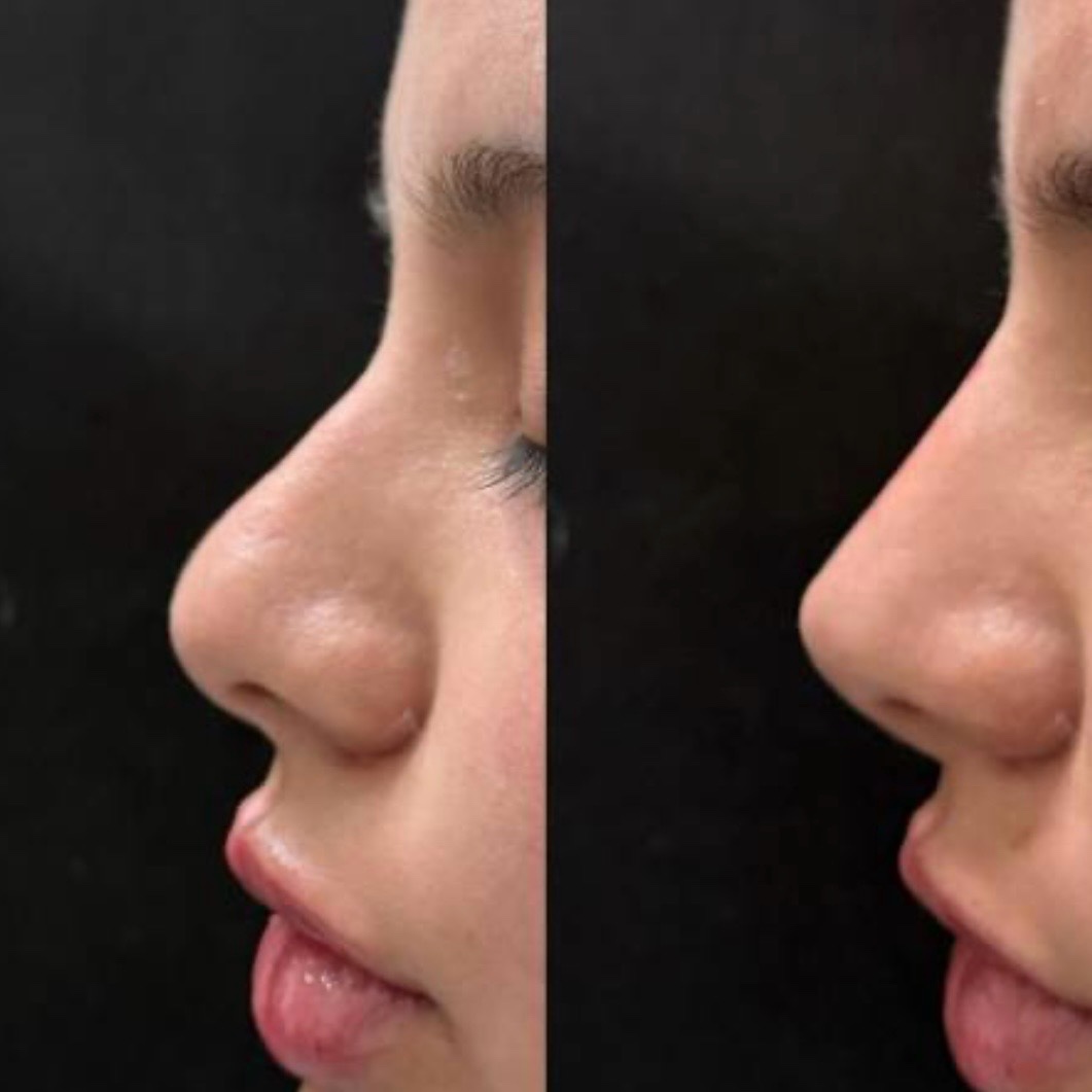 Before and after — non-surgical rhinoplasty