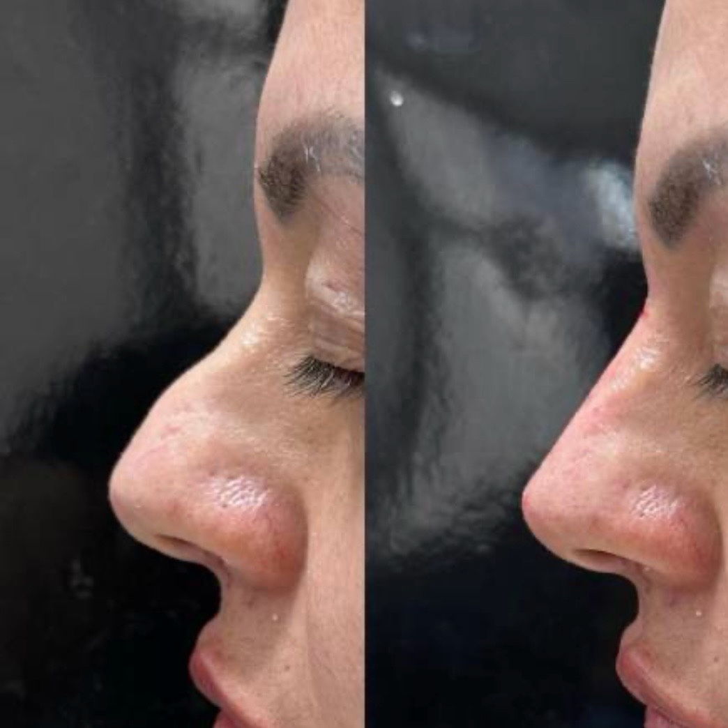 Before and after — non-surgical rhinoplasty