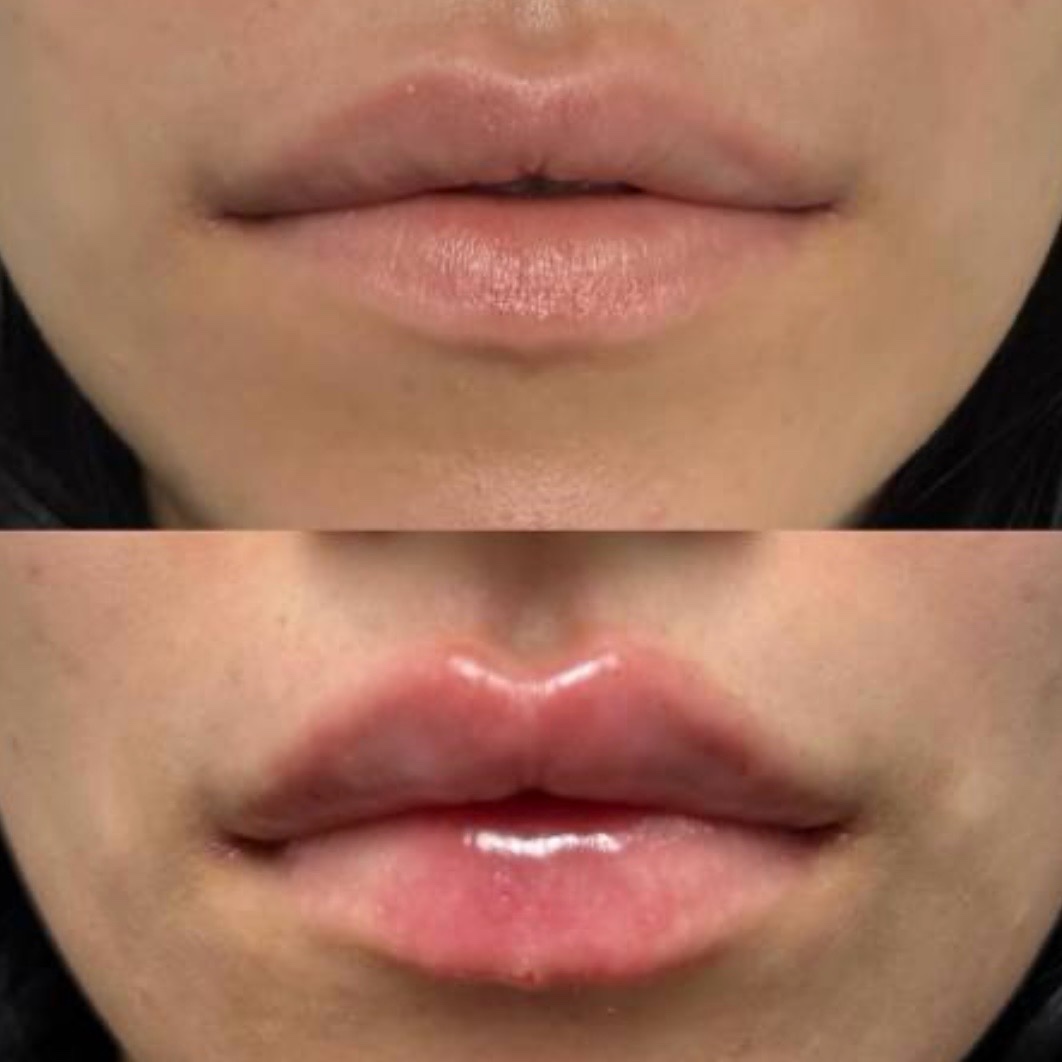Before and after — lip augmentation
