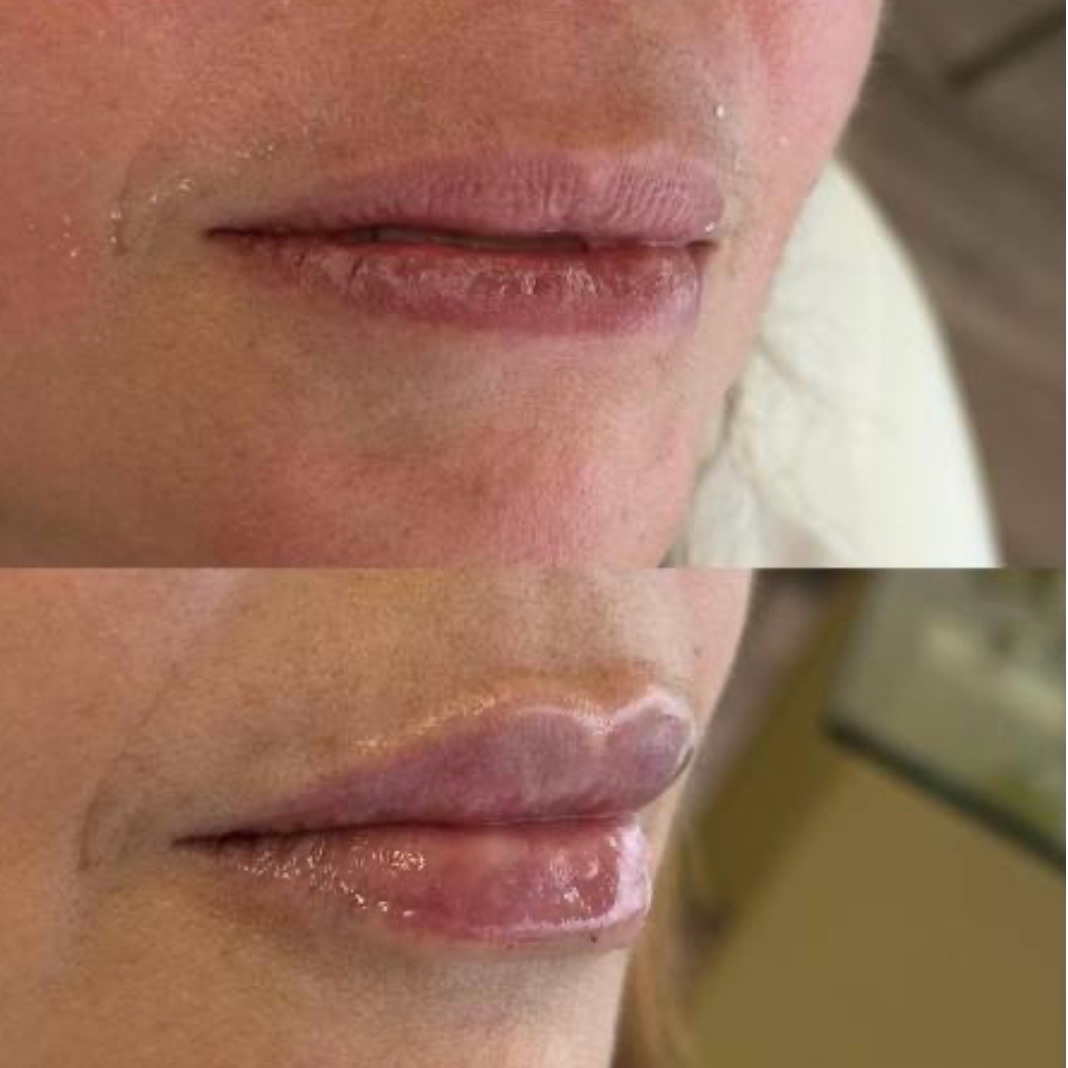 Before and after — lip augmentation