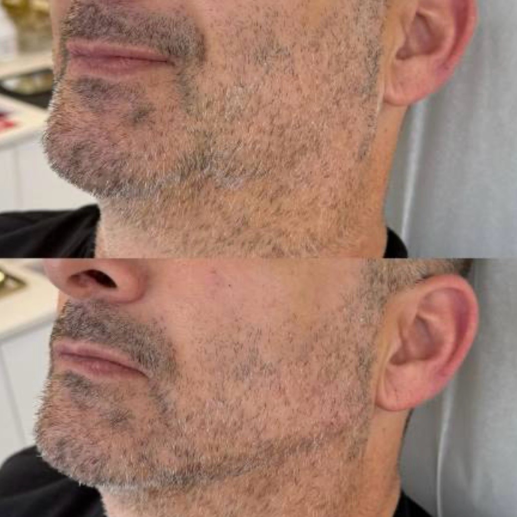 Before and after — facial contouring