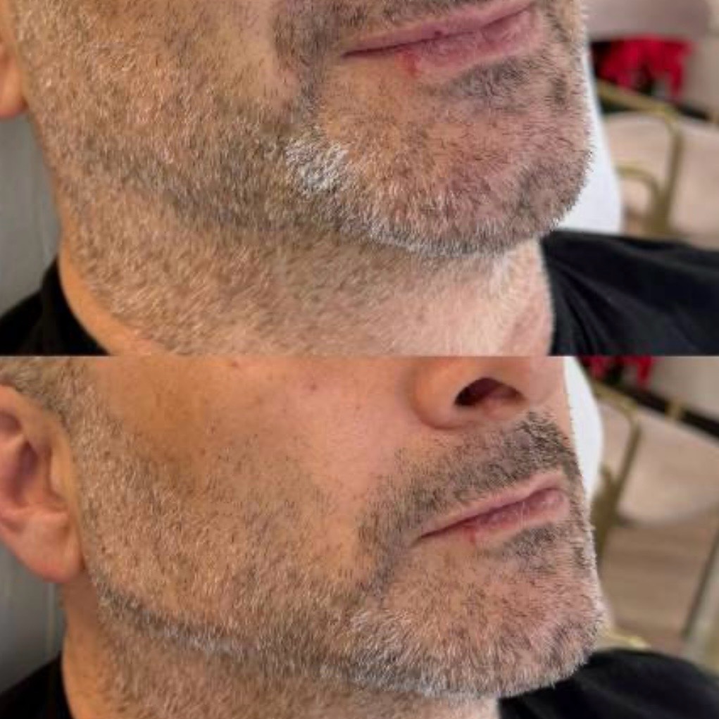Before and after — jawline definition