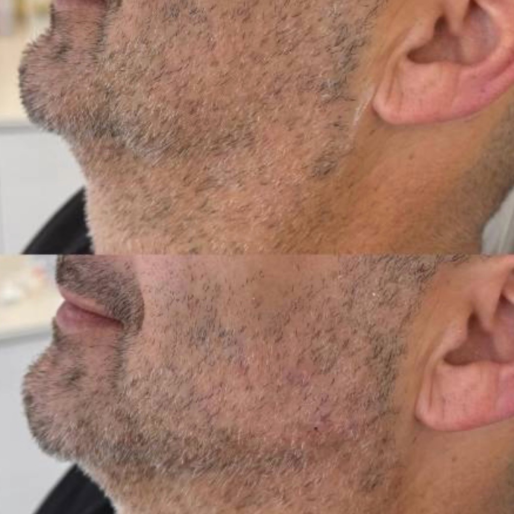 Before and after — facial contouring
