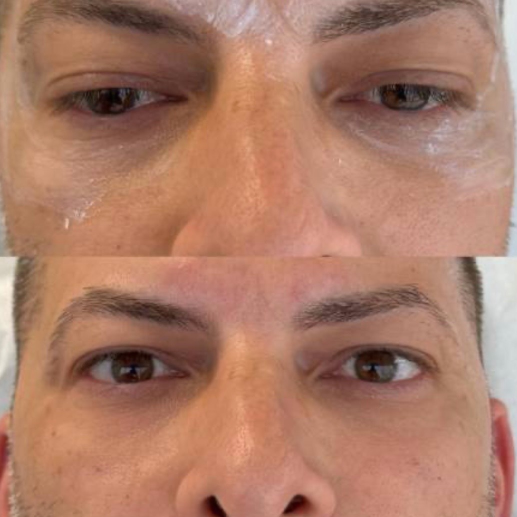 Before and after — eye rejuvenation