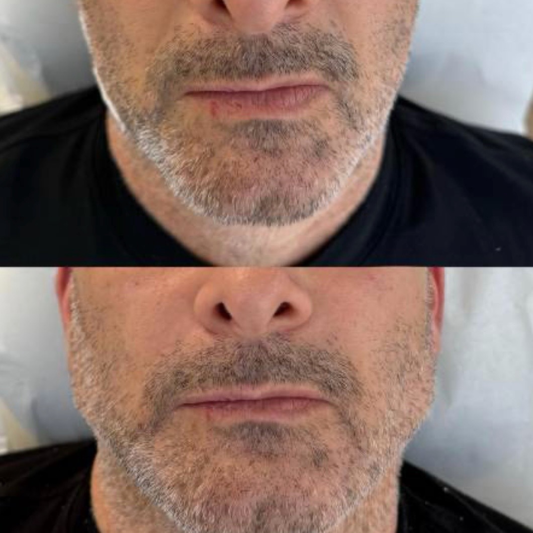 Before and after — jawline definition