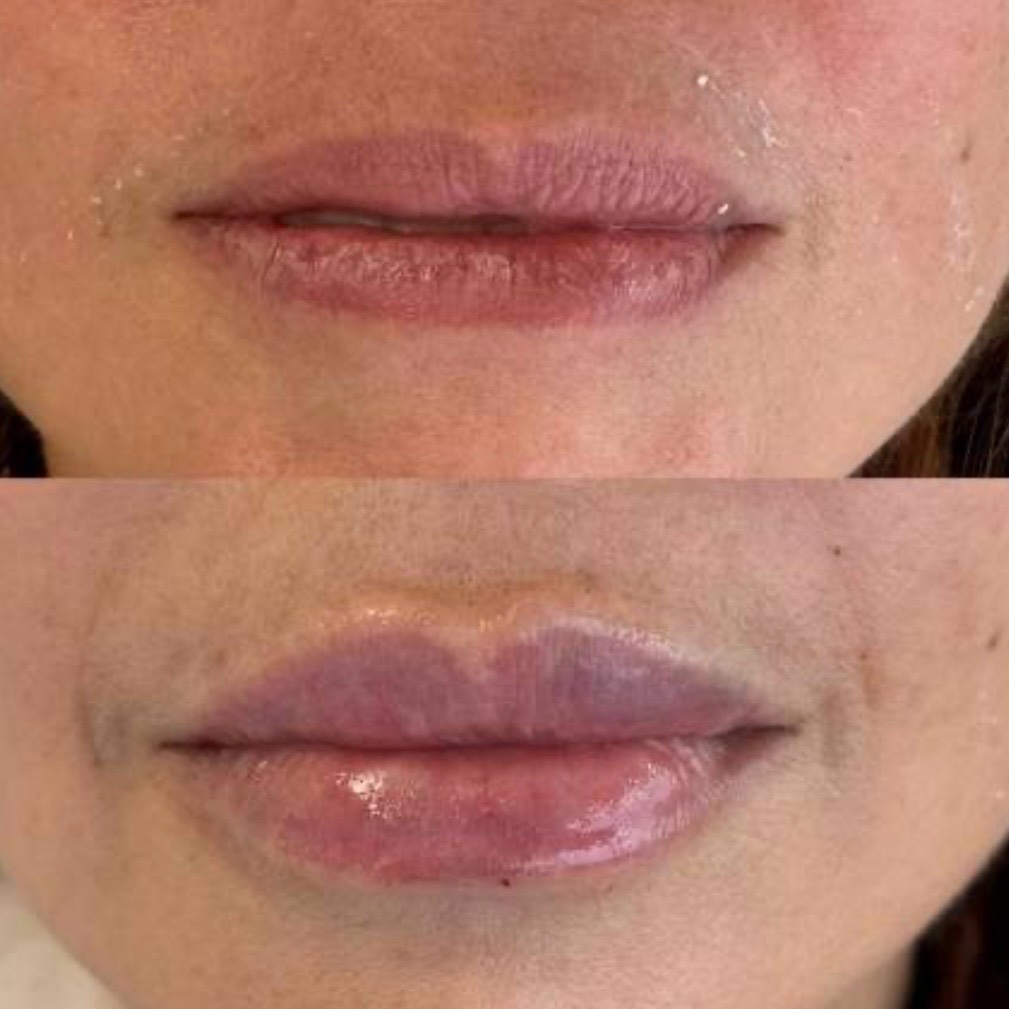 Before and after — lip augmentation