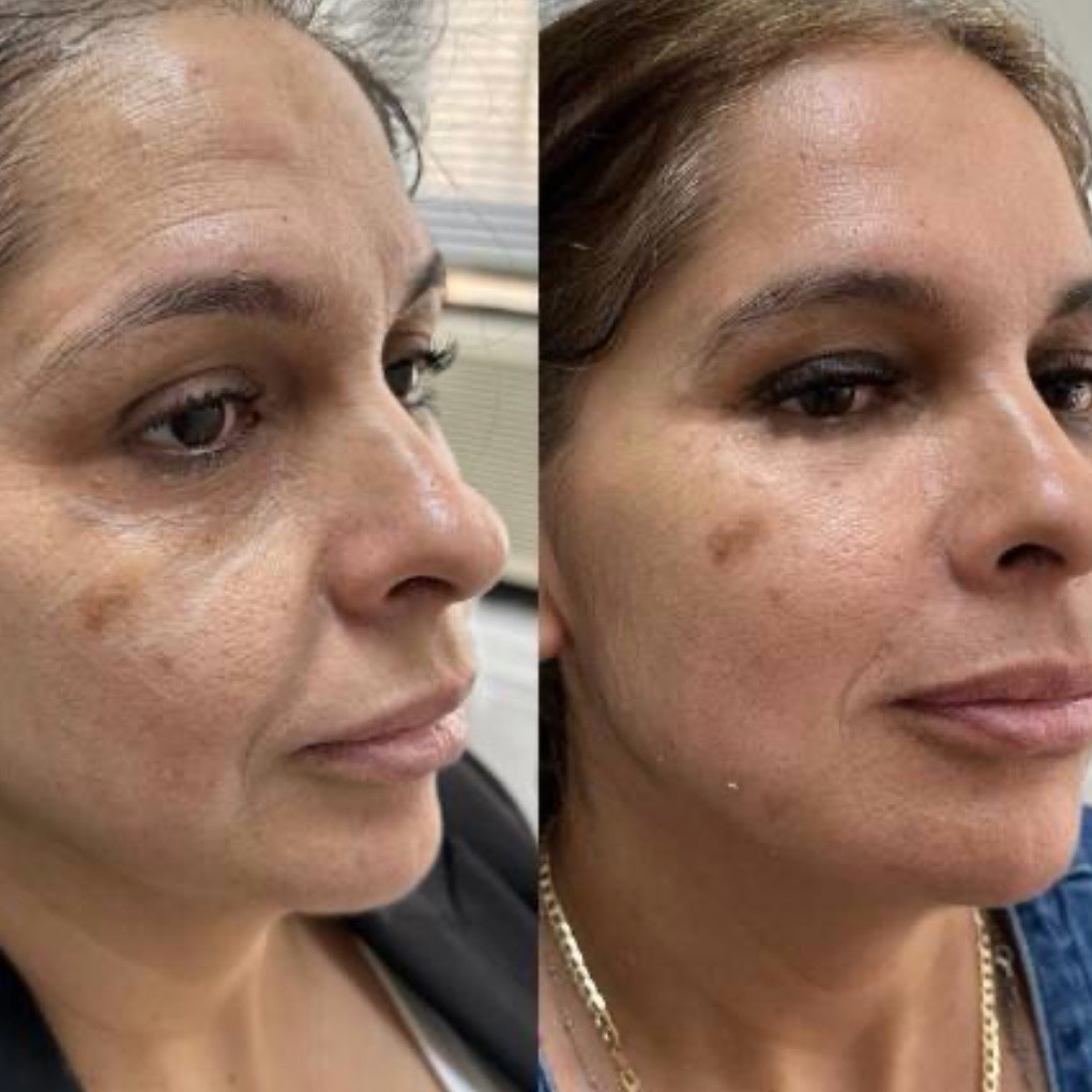 Before and after — facial harmonization