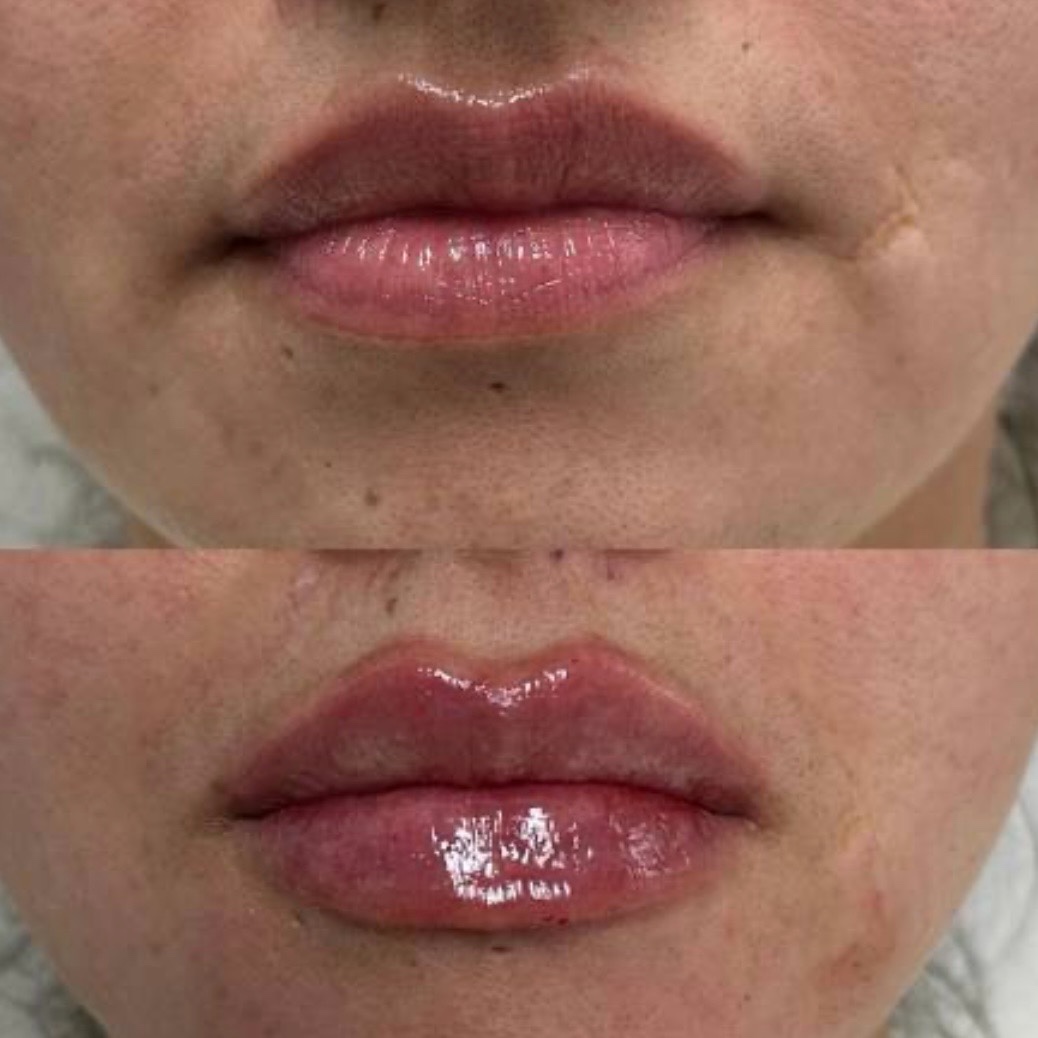 Before and after — lip augmentation